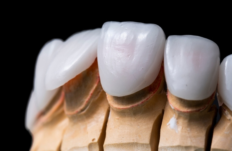 things to consider while taking care of your veneers