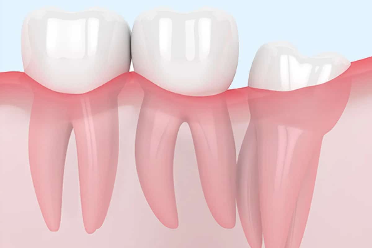 Types Of Oral Surgeries Exploring Common Procedures
