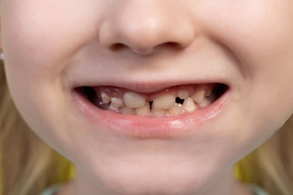 Tips to Avoid Tooth Staining And Discoloration