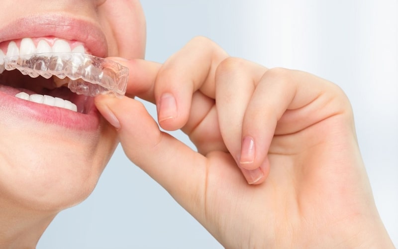 10 Reasons To Choose Invisalign Over Traditional Braces