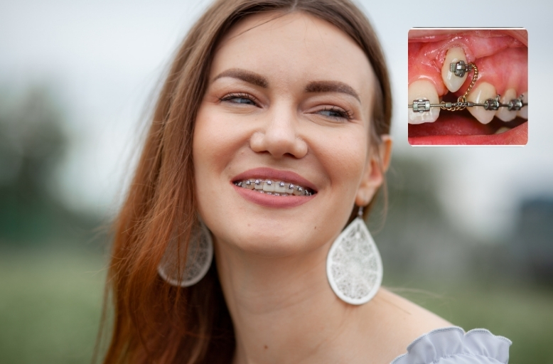 Woman with braces undergoing impacted canine orthodontic treatment in Spokane Valley
