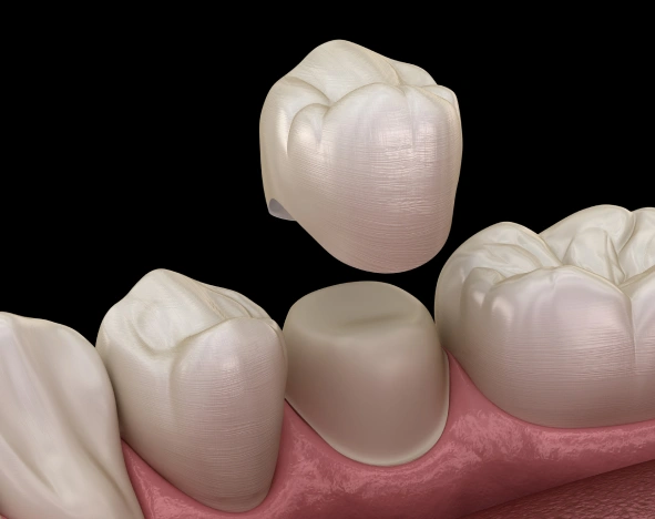 ceramic dental crowns in hagerstown