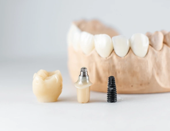 mini dental implants in hagerstown