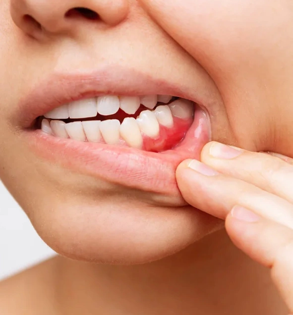 periodontal treatment in hagerstown