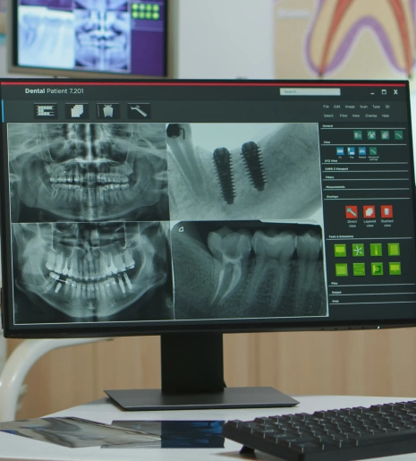 Digital Workflow for Advanced Full Mouth Implant Treatments