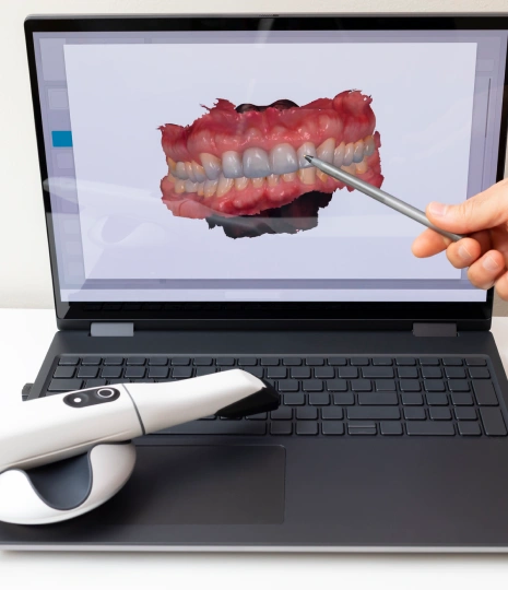 Intra Oral Scanners and Digital Impressions