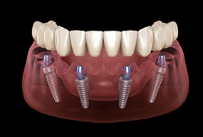 All-on-4 Implants