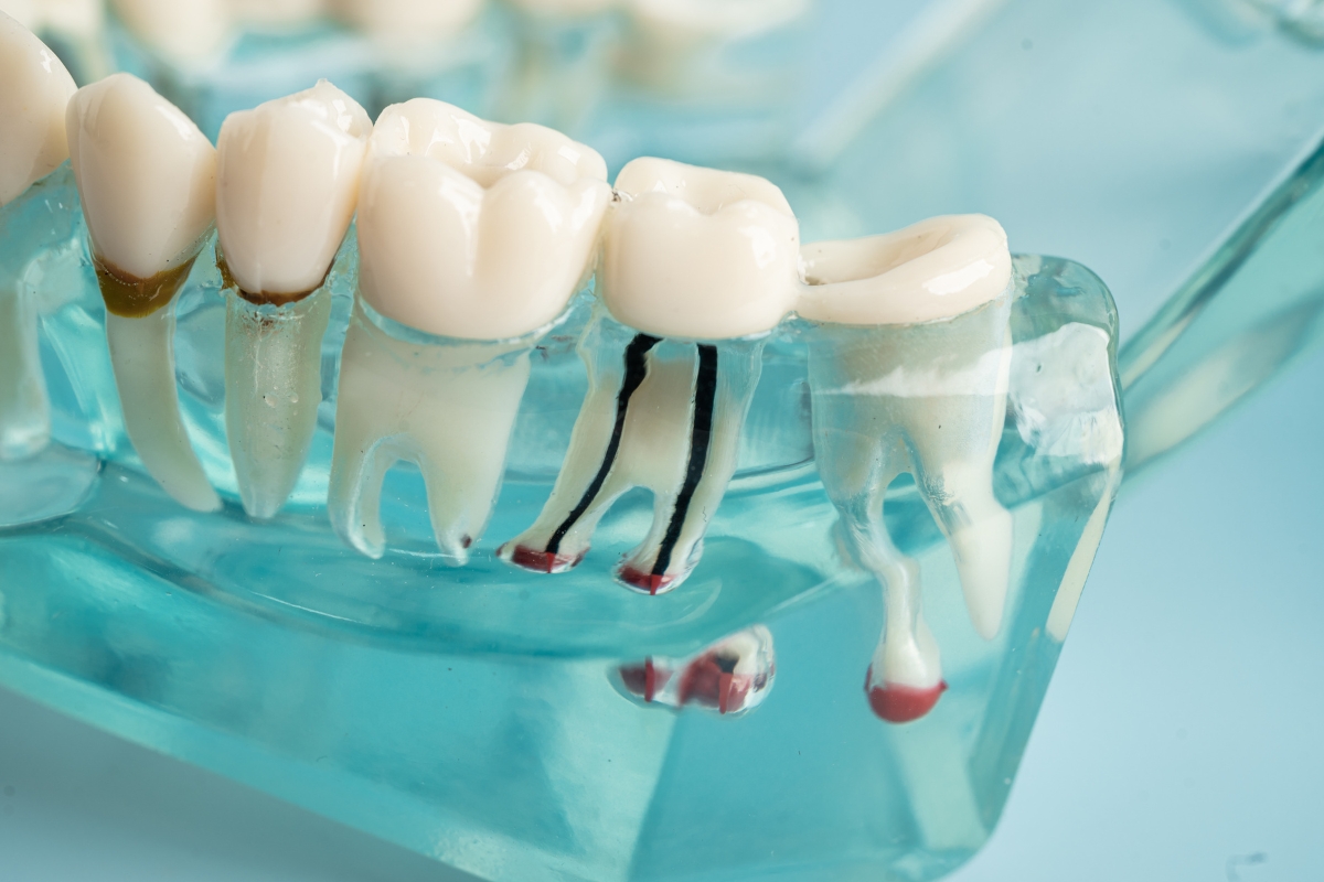 root-canal-therapy-in-Decatur