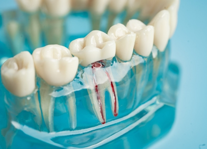 root canal treatment what to expect and how it saves your tooth