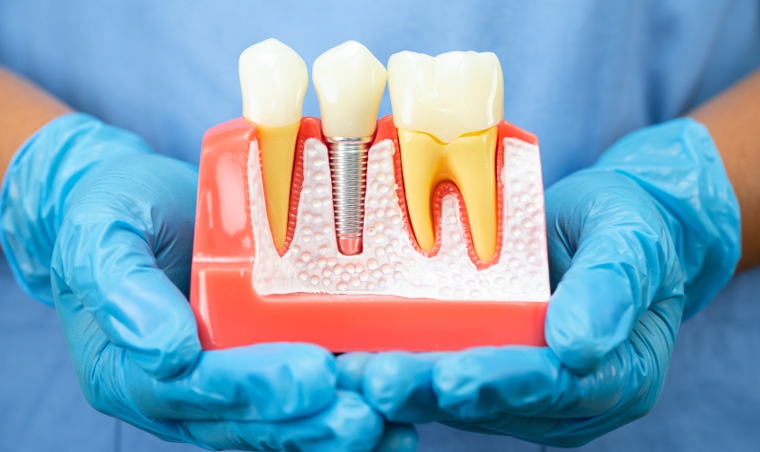 Natural Smile with Tooth-Colored Fillings