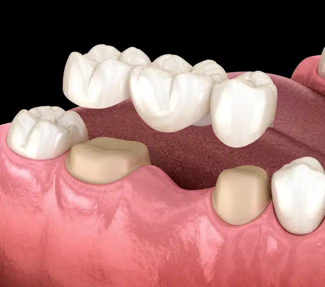 Dental Crowns