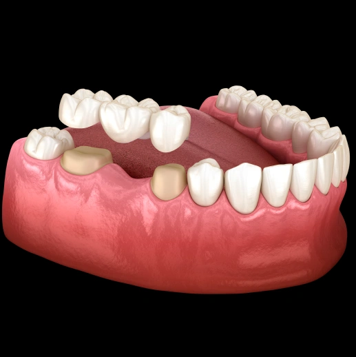 dental-bridges