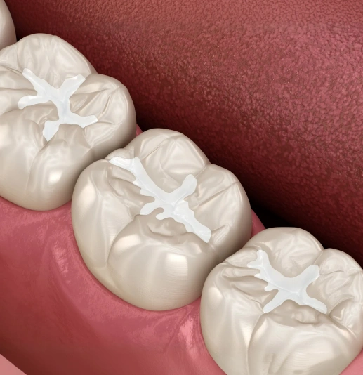 dental-sealants