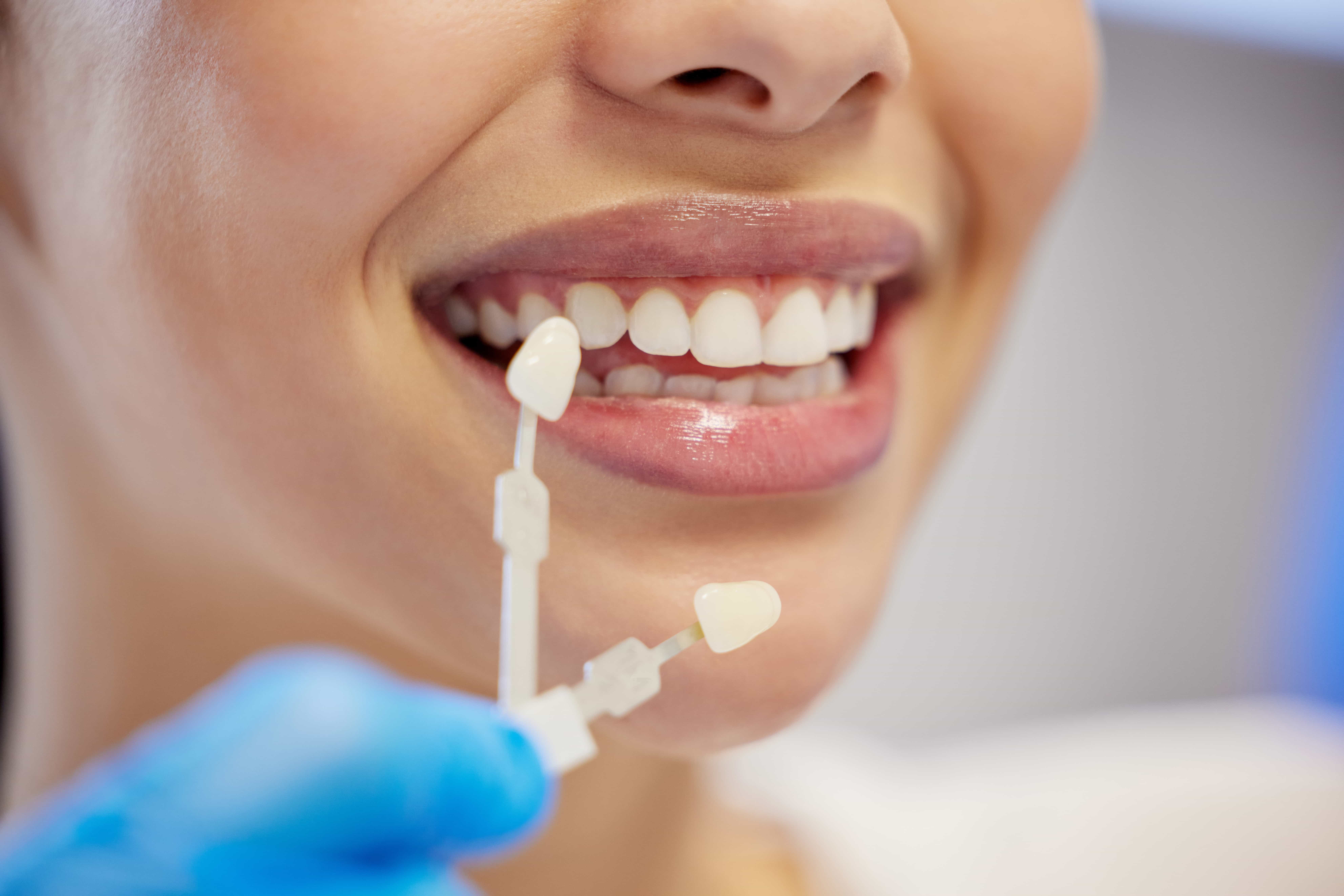 Does Dental Insurance Cover Veneers