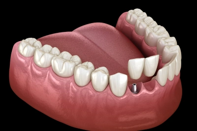 Cantilever dental bridge supported by one adjacent tooth in Carthage