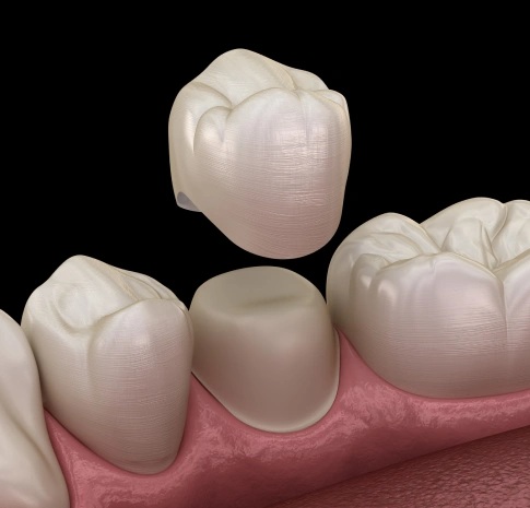 Dental crown placement showing tooth cap restoring damaged tooth in Carthage
