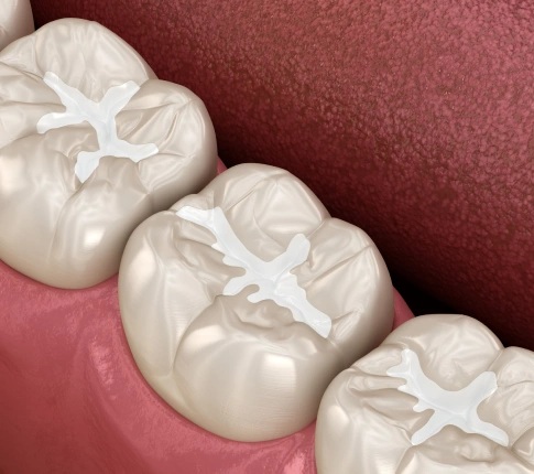 Dental sealants applied on molars to protect teeth from cavities in Carthage