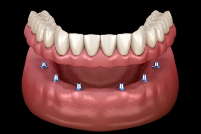 Full mouth dental implants replacing all teeth with permanent solution in Carthage