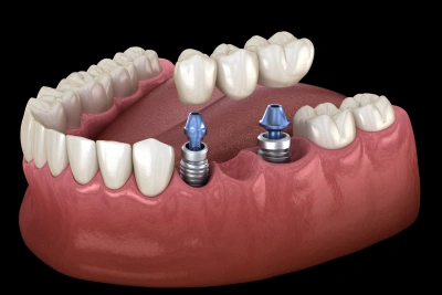Implant supported bridge replacing multiple missing teeth in Carthage