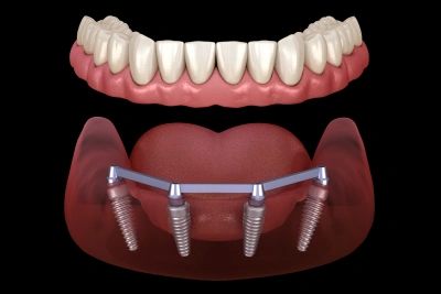 Implant supported dentures All-on-4 restoring full arch teeth in Carthage