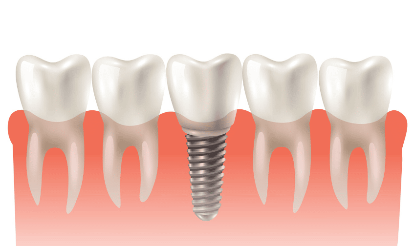 Why Dental Implants Are Better Than Dentures