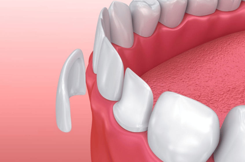 How to Select the Right Type of Dental Veneers for You