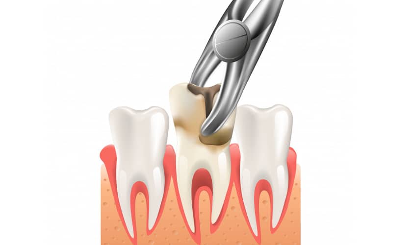 Get To Know About Tooth Extraction