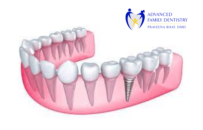 All You Need To Know About Recovery Time of Dental Implants