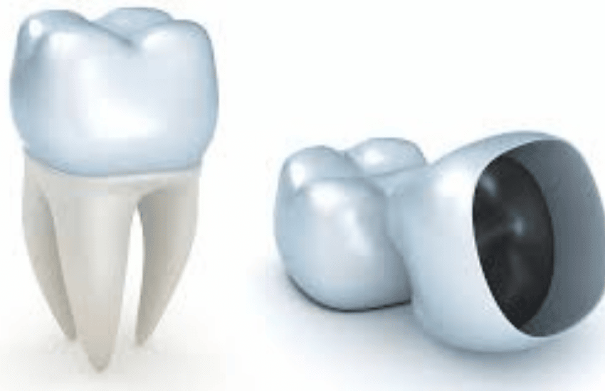 CAD/CAM restoration