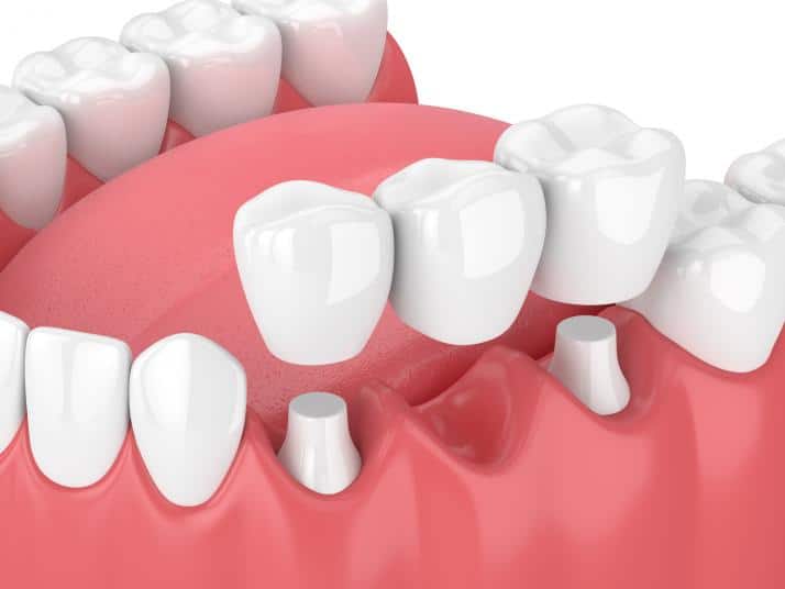 The Benefits Of Dental Bridges: Restoring Your Smile And Functionality