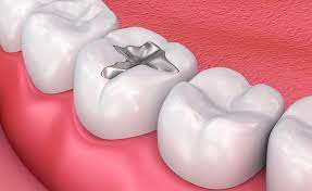 The Process Of Getting A Dental Filling: What To Expect