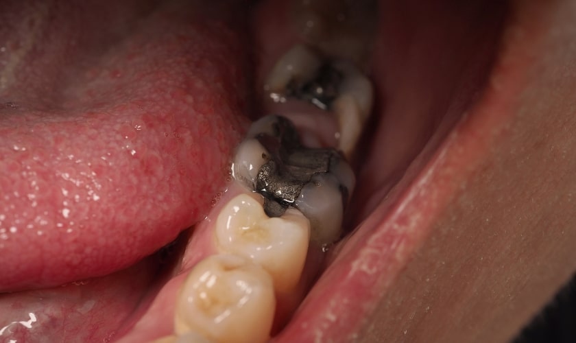 Root Canal Treatment Advances To Watch For This Year