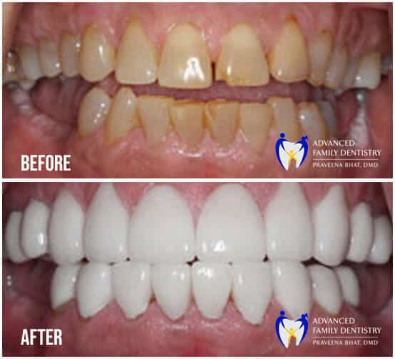 Before and After image of Veneers treatment in Nashua NH