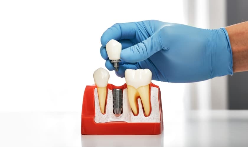 What Are The 3 Types of Dental Implants?
