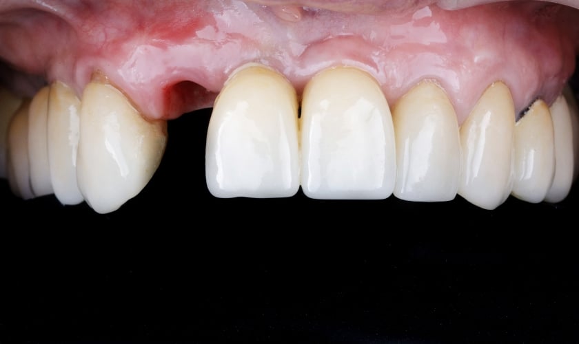 Advanced Family Dentist Nashua: How Long Does It Take For A Loose Tooth To Tighten Back Up?