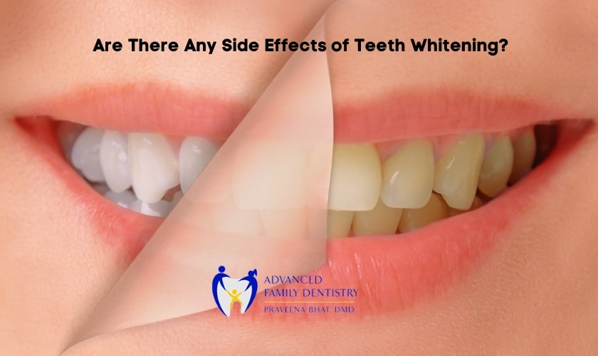 Are There Any Side Effects of Teeth Whitening?