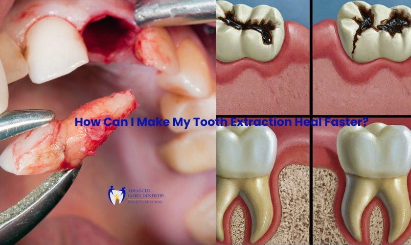 How Can I Make My Tooth Extraction Heal Faster?