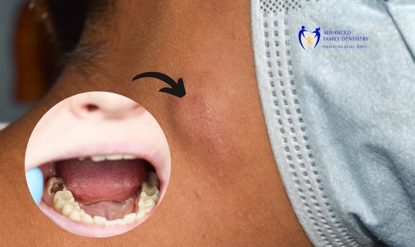 Can a Cavity Cause Swollen Lymph Nodes