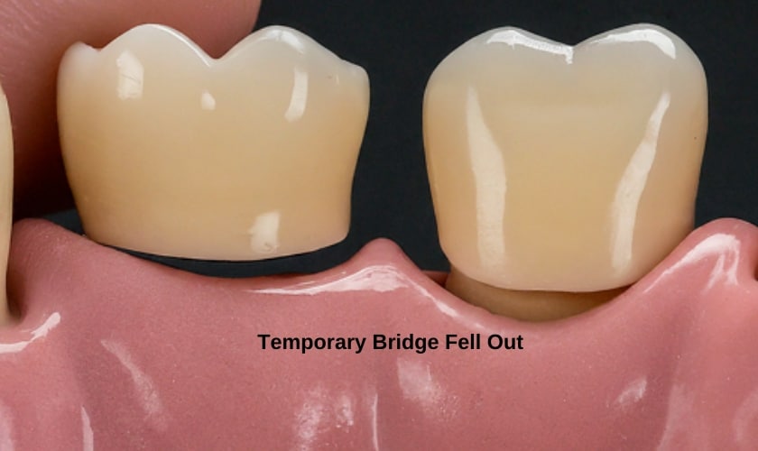 Temporary Bridge Fell Out? What You Need to Do Immediately