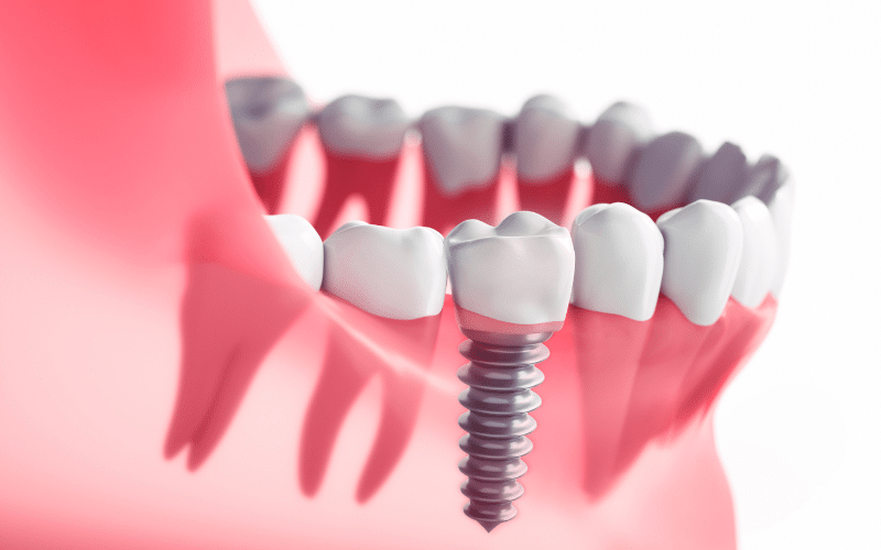 Dental Implants Placement