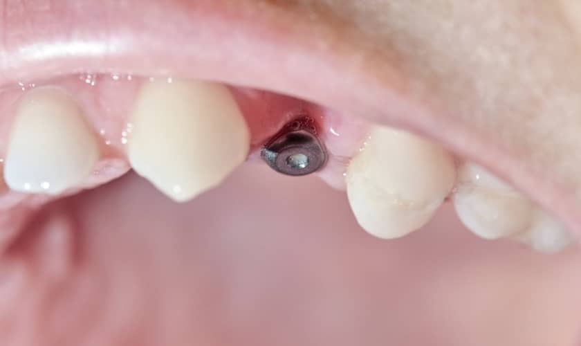 Are Mini Dental Implants A Quick Fix Or Long-Term Solution?