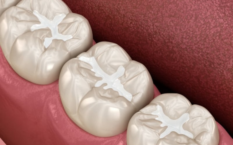 How To Choose The Right Dentist For Your Composite Fillings In Nashua