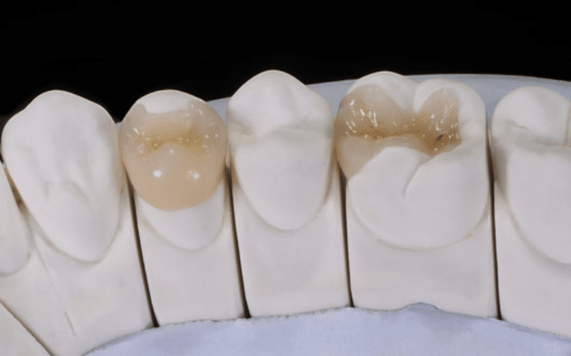 Advantages Of Inlays and Onlays