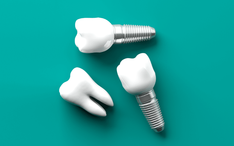 How To Care For Mini Dental Implants