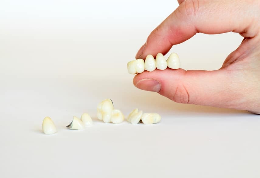 choosing dental bridges for missing teeth