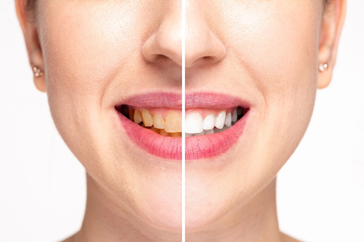 teeth-whitening-in-Nashua