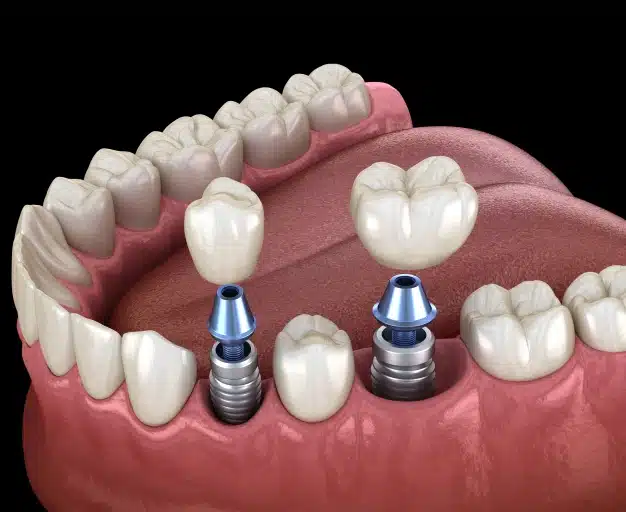 Dental Implant Restoration in Plant City, FL - Horizon Dental Designs