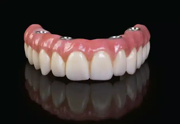 Implant-Supported Dentures in Plant City, FL - Horizon Dental Designs