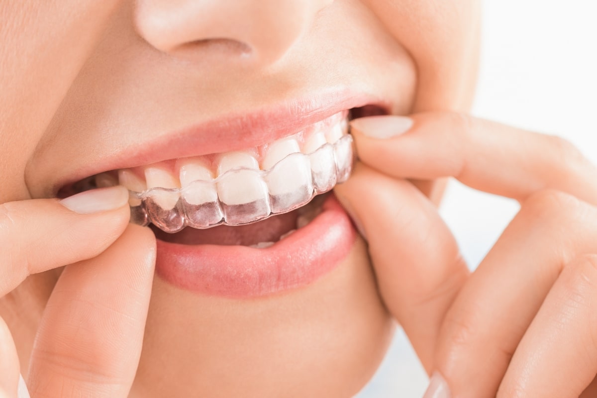 clear aligners in Plant City