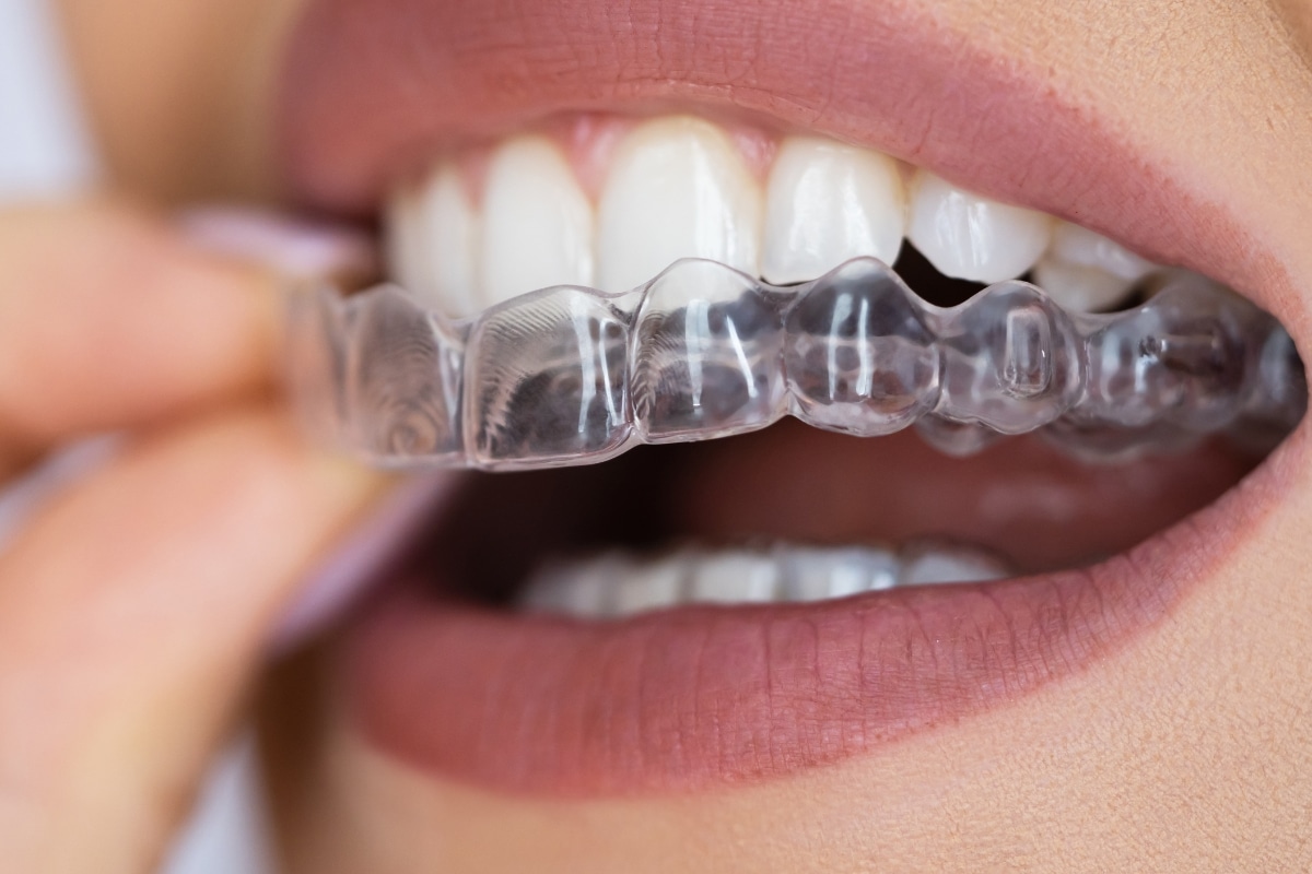 clear-aligners-in-Plant-City-FL